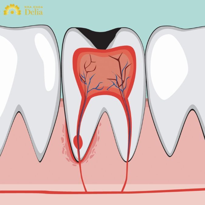 Viêm tủy răng gây ra tình trạng chân răng bị hôi