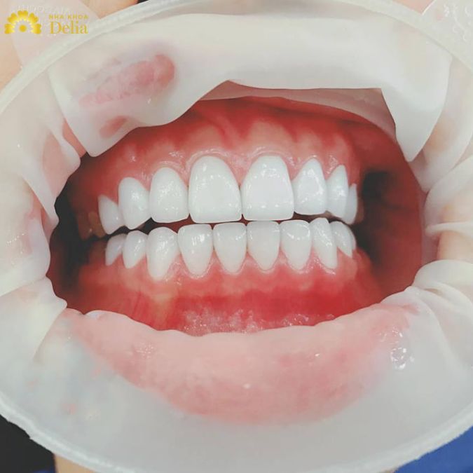 Kiểm tra nha sĩ định kỳ để bảo vệ sức khỏe răng miệng