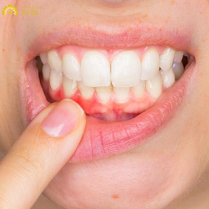 Bệnh thường gặp ở chân răng cửa chính là viêm lợi