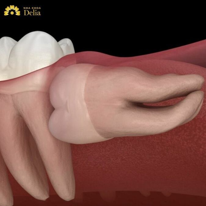 Chân răng số 8 thường mọc trong độ tuổi từ 17 - 25