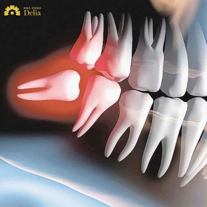 Chân răng khôn mọc ở phía trong cùng của hàm