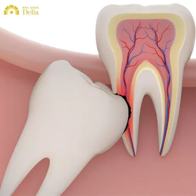 Tình trạng đau nhức khó chịu có thể xảy ra khi chân răng số 8 mọc