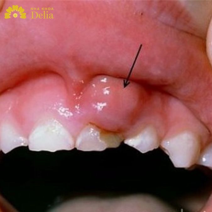 U hạt nhiễm khuẩn gây ra đau nhức và hình thành khối u ở chân răng