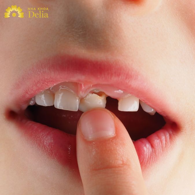Đa phần răng sữa tự lung lay