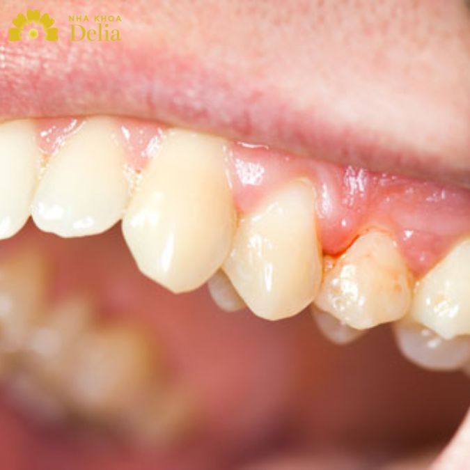 Thiếu vitamin khiến chân răng không còn chắc khỏe và dễ lung lay