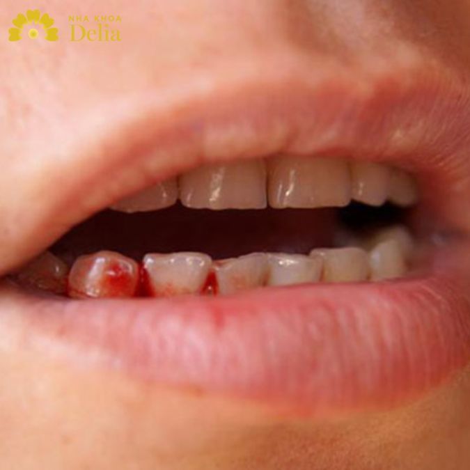 Việc cơ thể không đủ dinh dưỡng cần thiết khiến răng dễ chảy máu và lung lay