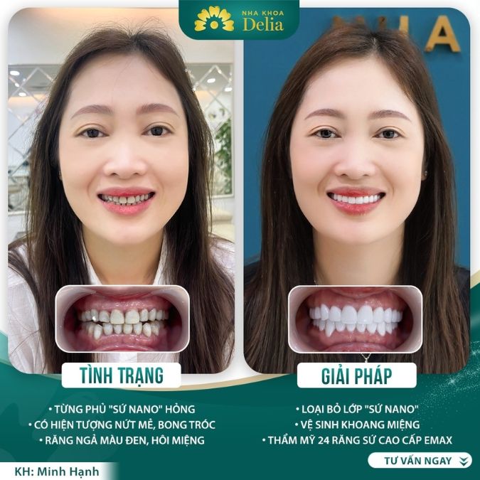 Có nên súc nước muối sau khi bọc răng sứ