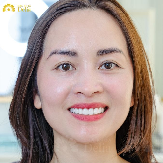 Chị Hẳng - Thanh Hóa: Chị cảm thấy rất vui vì sở hữu một hàm răng trắng sáng. Trước tình trạng tụt lợi ở răng khi chị tự ti lắm. Sau khi bọc sứ chị tự tin và cười nhiều hơn hẳn.