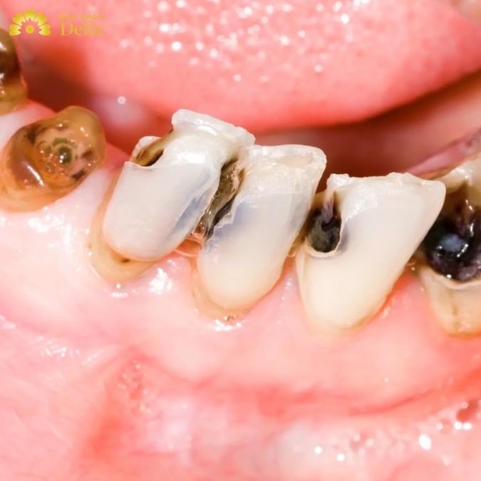 Không chỉ chân răng bị đau mà còn kèm theo các cơn đau nhức, khó chịu ở xung quanh vùng nướu lân cận