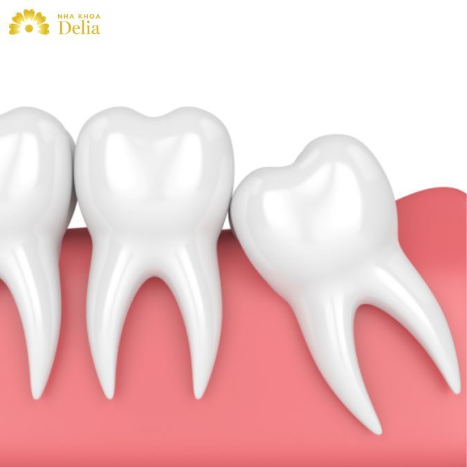 Khi răng khôn mọc cũng có thể gây ra tình trạng chân răng ê buốt và đau nhức