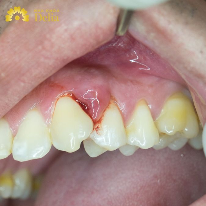 Đau nhức chân răng hàm dưới tiềm ẩn rất nhiều bệnh lý liên quan đến răng miệng