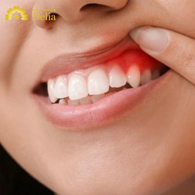 Viêm nha chu gây ra tình trạng đau nhức chân răng hàm trên thậm chí rụng răng