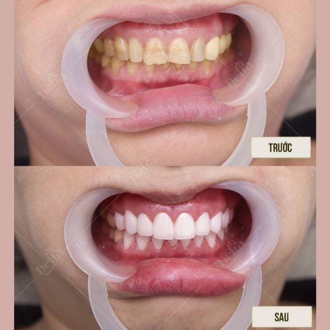 Bọc răng sứ không mài không mài nhỏ, không ảnh hưởng tủy răng
