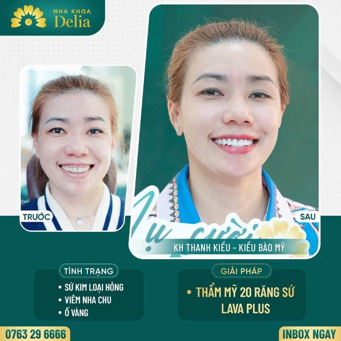 Bảng giá bọc răng sứ tại Hà Nội | Giá bọc răng sứ nha khoa Delia mới nhất 