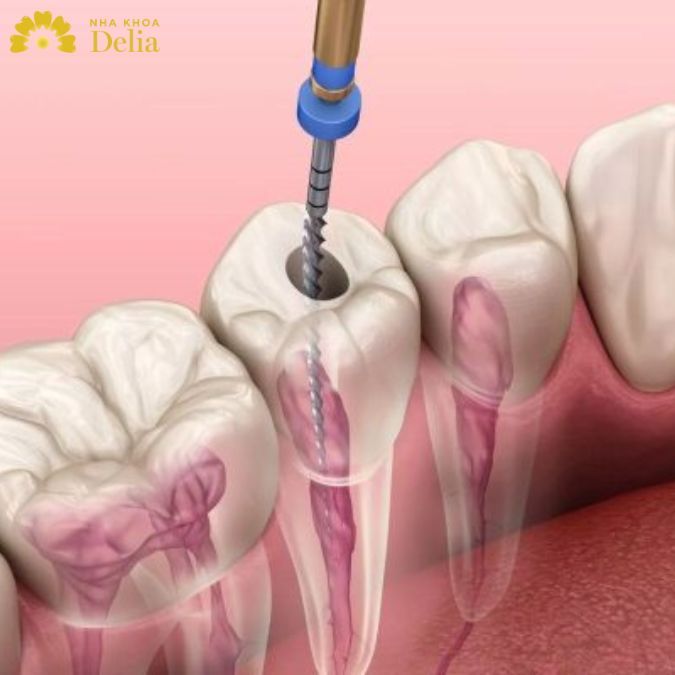 Viêm tủy răng là tác hại khi bọc sứ ở địa chỉ kém uy tín