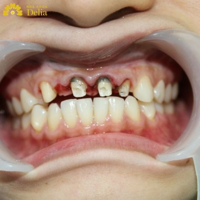 Răng gốc bị hỏng hoàn toàn khi làm răng sứ ở nơi kém chất lượng