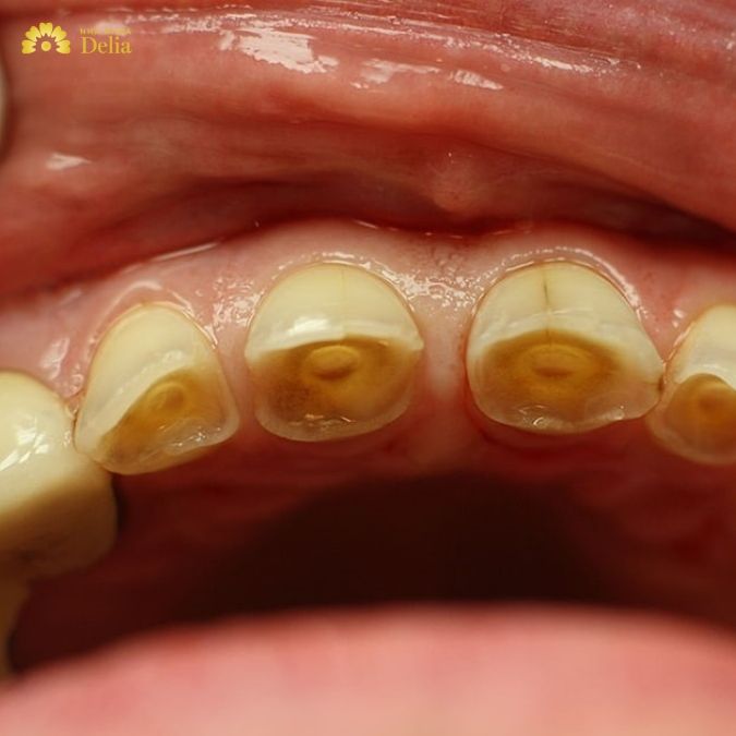 Hình ảnh răng bị mòn men răng