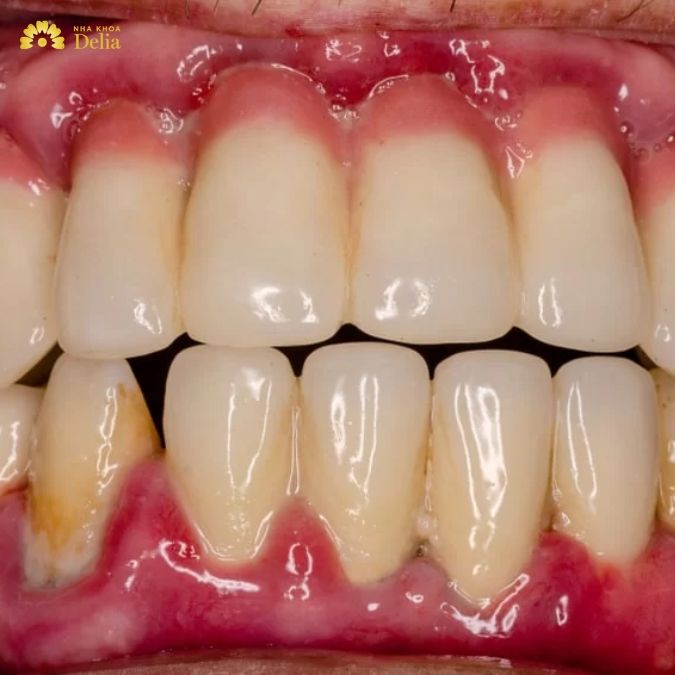 Hình ảnh răng bị viêm nha chu