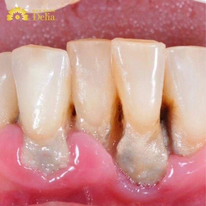 Bọc răng sứ bị tụt lợi, hở chân răng