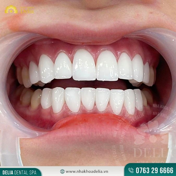 Răng toàn sứ Emax - dòng răng sứ được hơn 50% khách hàng tại Delia tin tưởng lựa chọn