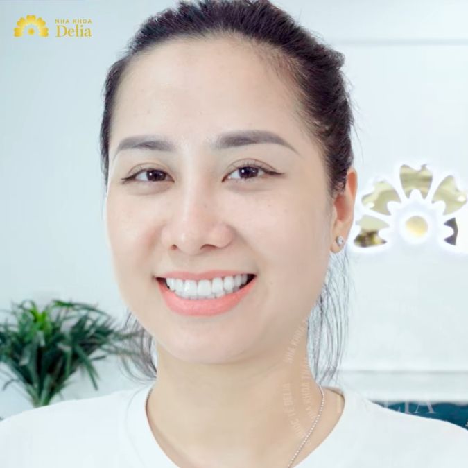Đặc điểm nổi bật của răng sứ Emax