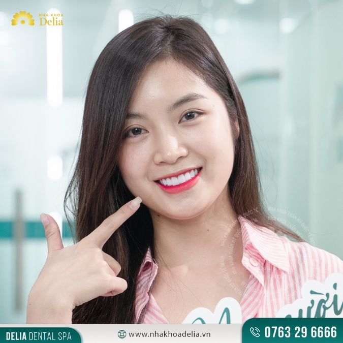 Đặc điểm nổi bật của răng sứ HT Smile 