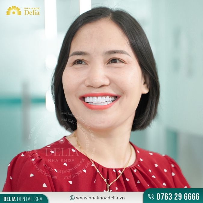 Khách hàng Trịnh Huyền trải nghiệm làm 23 răng sứ HT Smile tại nha khoa Delia