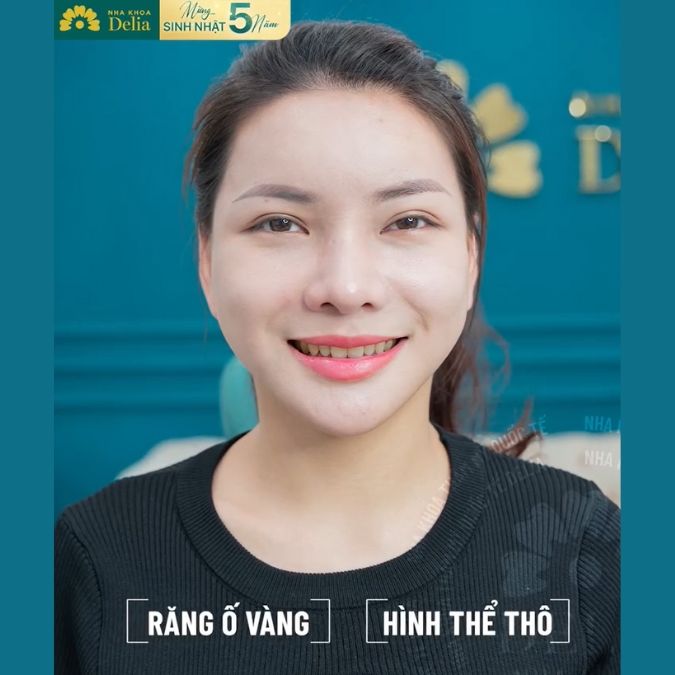 Khách hàng Nguyễn Vân Anh trải nghiệm thẩm mỹ 18 răng sứ Lava Plus tại nha khoa Delia