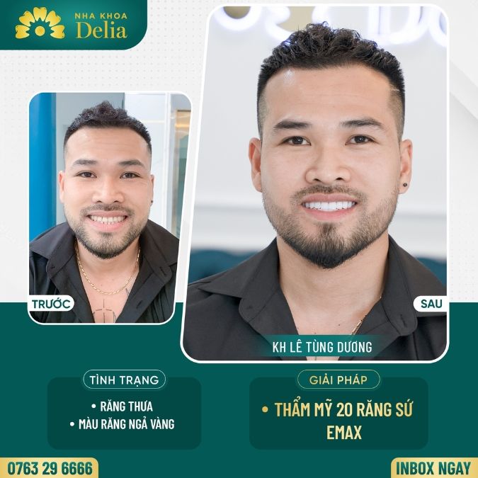 Nhược điểm của hình thức bọc răng sứ trả góp
