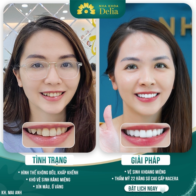 Ưu điểm nổi bật của hình thức bọc sứ cho răng hô nhẹ