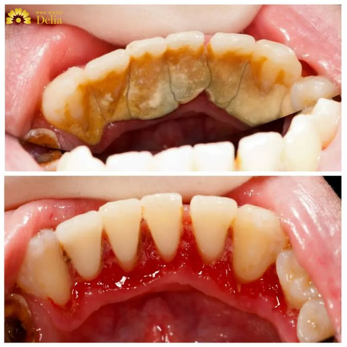 Bọc răng sứ cho răng bị nhiễm màu nặng