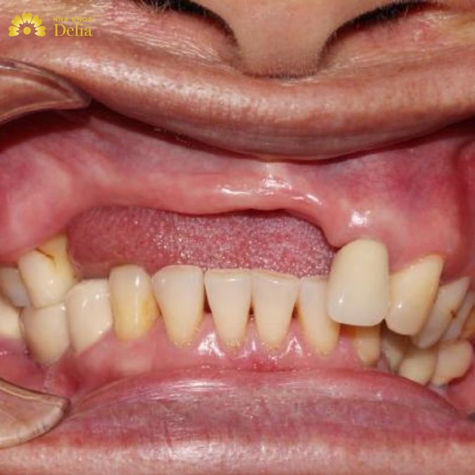 Mất răng có thể cân nhắc cấy ghép Implant hoặc cầu răng sứ