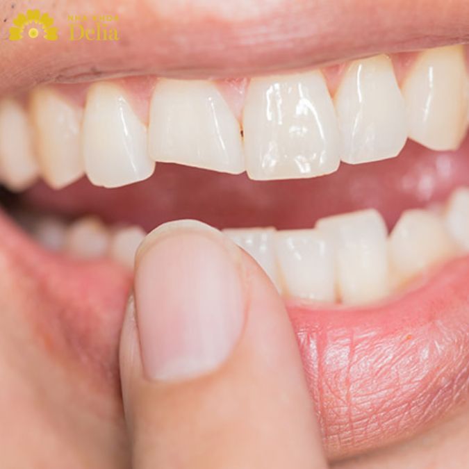 Chấn thương và va đập có thể gây nên tình trạng chân răng bị mẻ