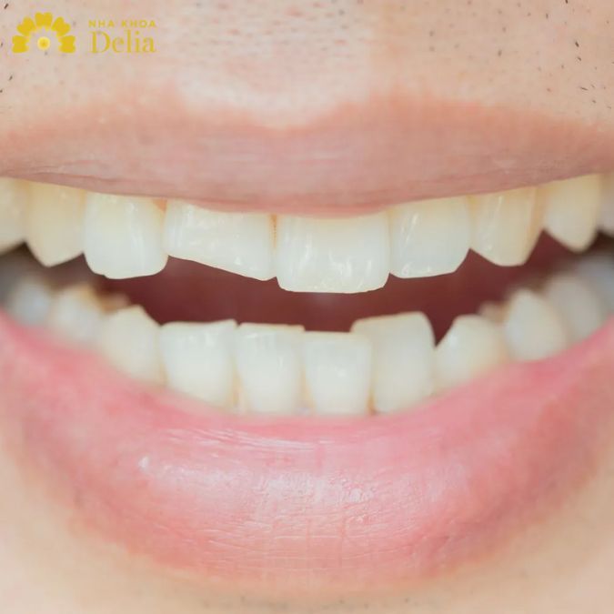 Mẻ chân răng không ảnh hưởng tới cấu trúc của răng