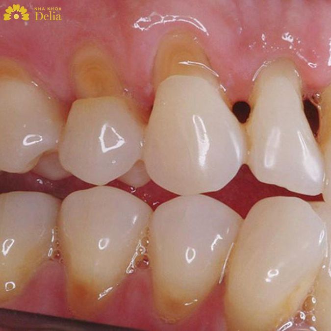 Mòn cổ chân răng là tình trạng mà nhiều người gặp phải