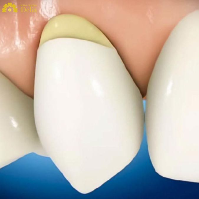Thăm khám nha sĩ định kỳ để phát hiện tình trạng cổ chân răng bị mòn sớm 