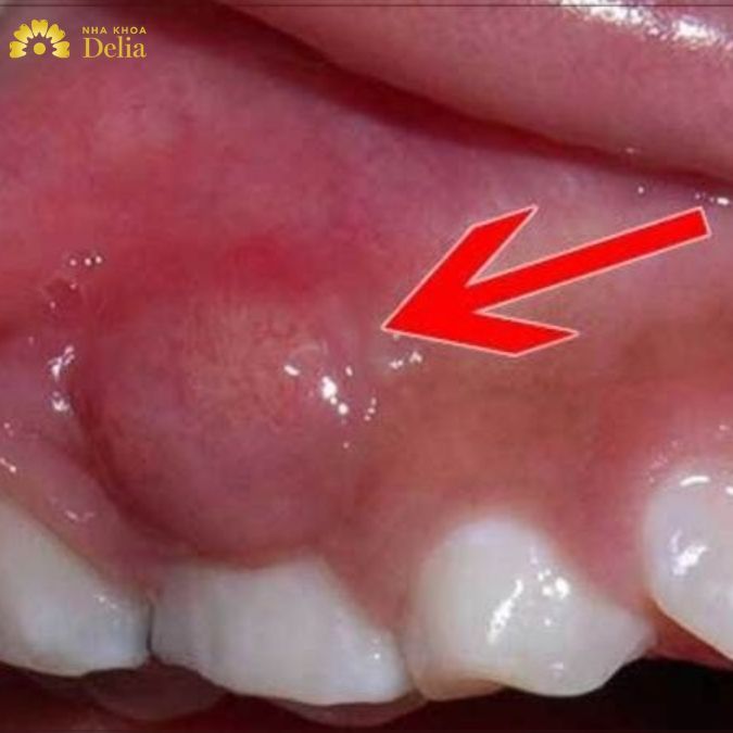 Chân răng xuất hiện khối u tiềm ẩn nhiều căn bệnh nguy hiểm