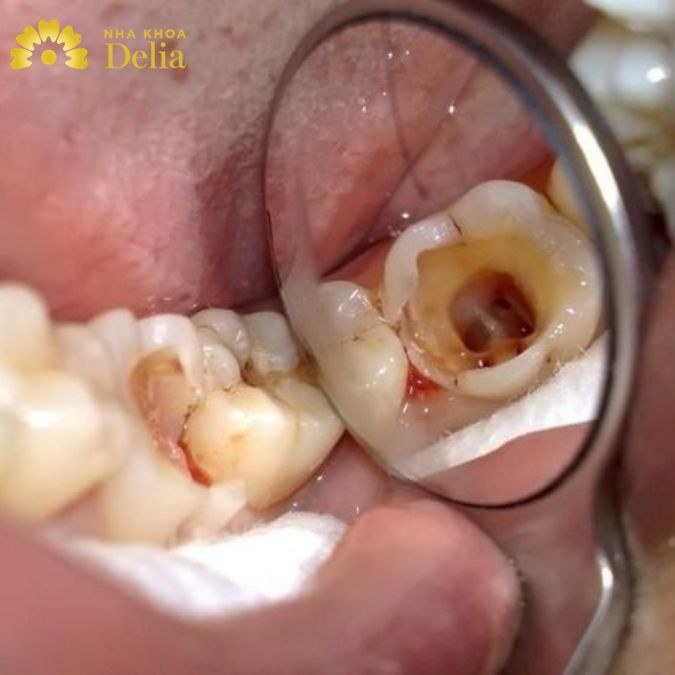 Sâu răng - Bệnh lý phổ biến khiến chân răng hàm dưới ê buốt đau nhức