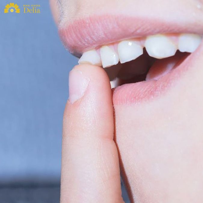 Răng lung lya, chân răng yếu không thích hợp để bọc răng sứ