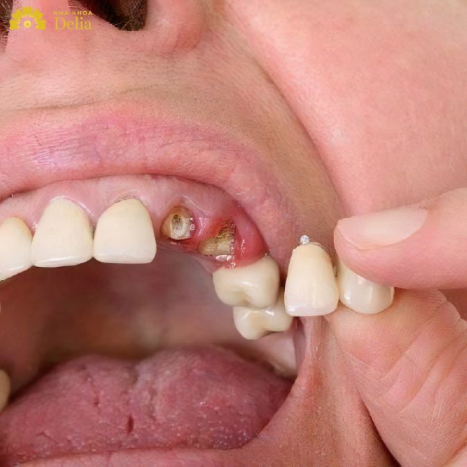 Răng tổn thương quá nặng không nên bọc sứ
