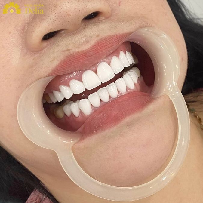 Thời gian bọc sứ cho răng khấp khểnh thường diễn ra trong 2 buổi thăm khám
