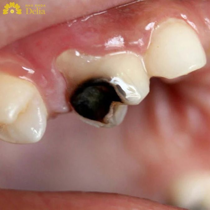 Răng bị sâu nên phục hình bằng phương pháp bọc răng sứ