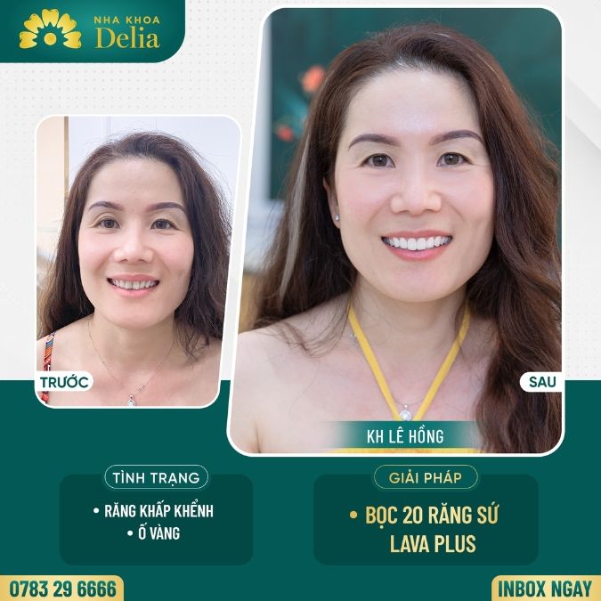 Khi nào thì nên dùng phương pháp bọc sứ cho răng sâu?