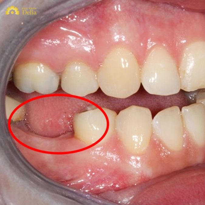 Điều gì sẽ xảy ra nếu sâu răng không được điều trị?