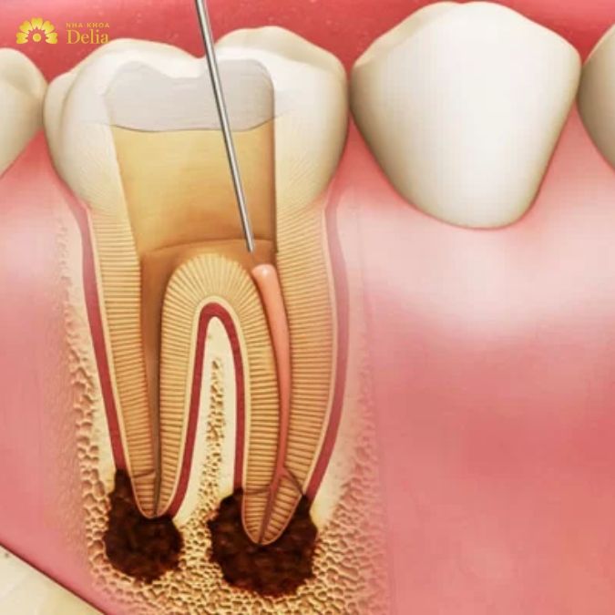 Điều gì sẽ xảy ra nếu sâu răng không được điều trị?