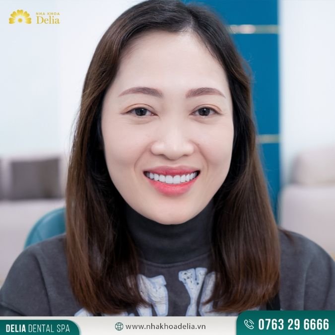 Quy trình bọc răng sứ cho răng sâu chuẩn quốc tế