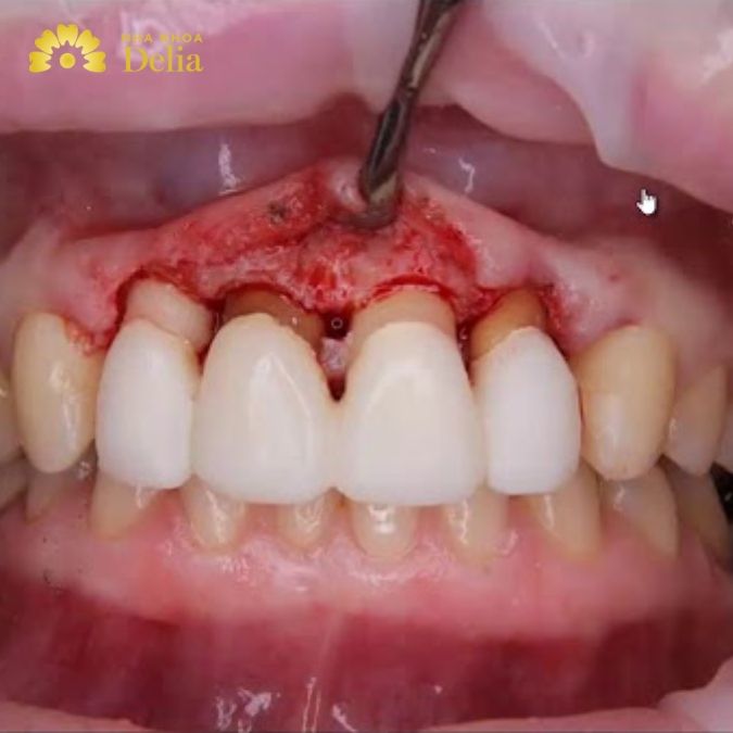 Răng bọc sứ bị nhiễm trùng chủ yếu do yếu tố nào?