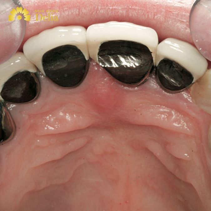 Răng bọc sứ bị nhiễm trùng chủ yếu do yếu tố nào?