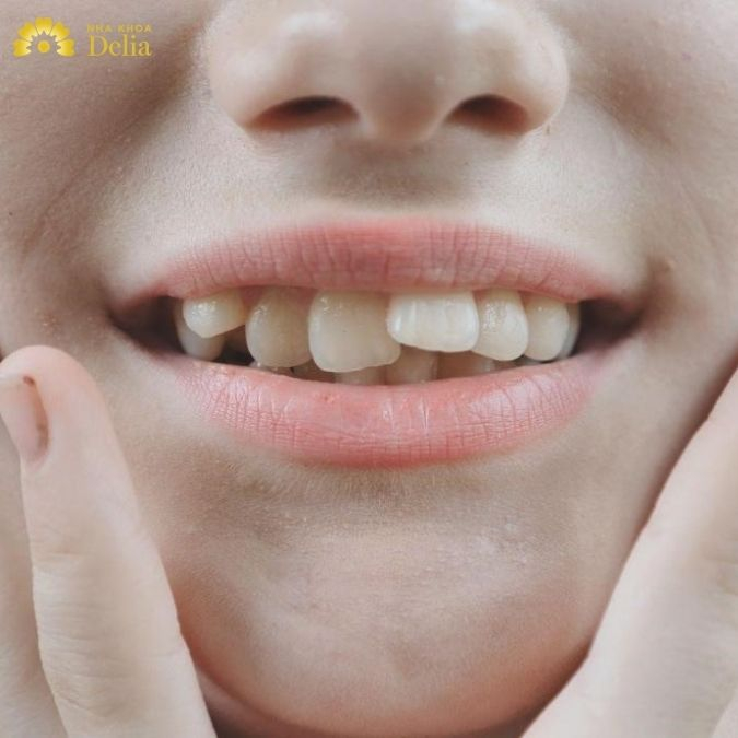 Răng lộn xộn ở mức độ nhẹ có thể cân nhắc bọc răng sứ