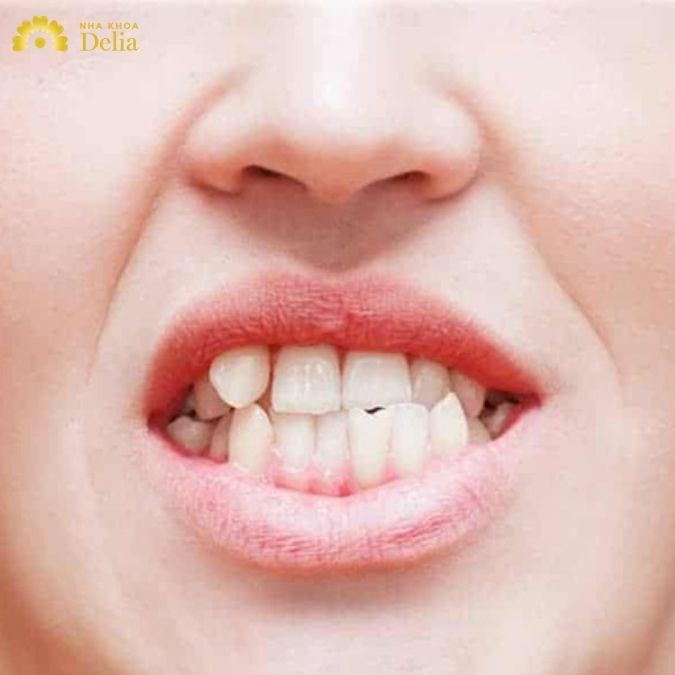 Niềng răng với trường hợp răng lộn xộn mức độ nặng